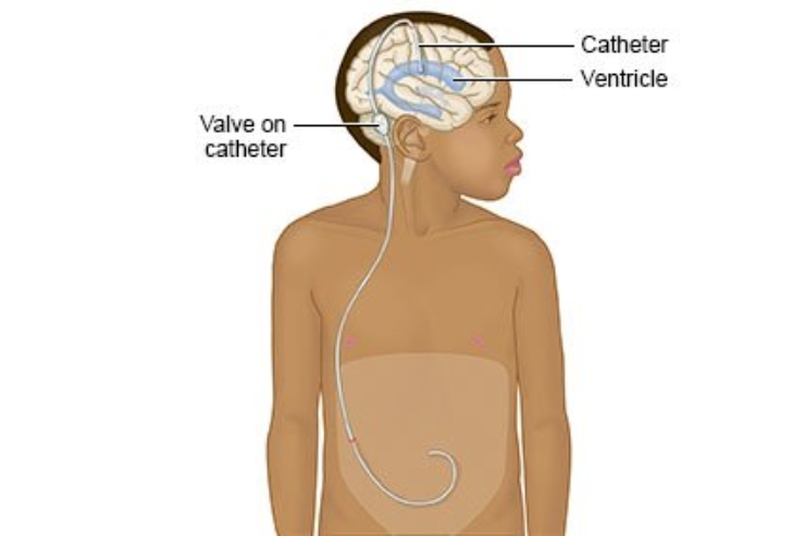 CSF Diversion Procedures (V-P Shunt)