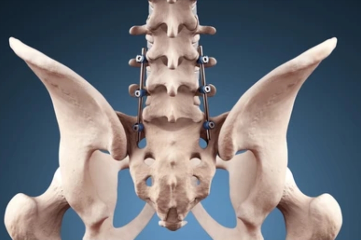 Corpectomy & Fusion