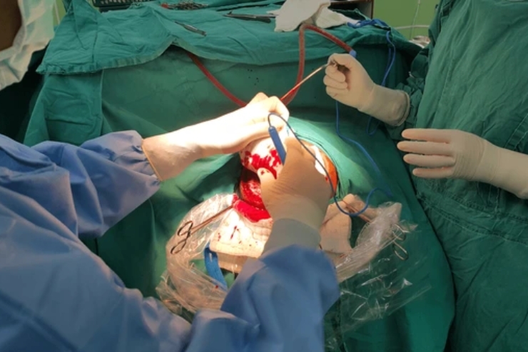 Craniovertebral Junction Surgeries