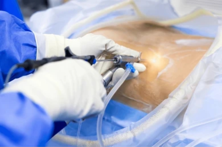 Endoscopic (Keyhole) Discectomy