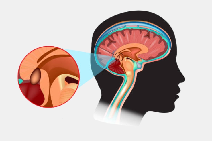 Endoscopic Pituitary Surgery