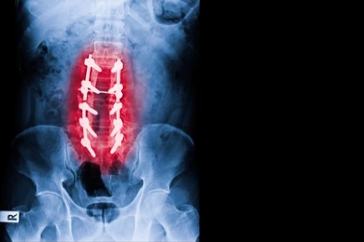 Laminectomy & Fusion (Spine Fixation)